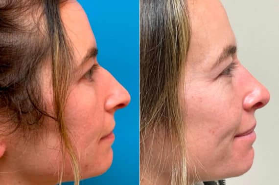 Early After-Surgery Results Before and After Photos in Sewell, NJ, Patient 9394