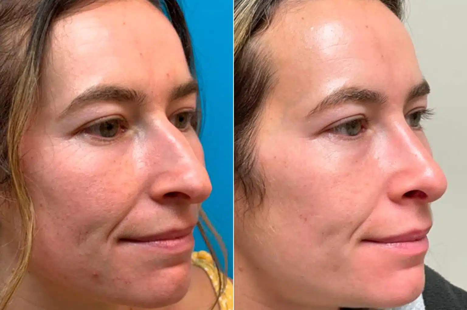 Bulbous Tip, Droopy Nose, Early AfterSurgery Results, Nasal Bump