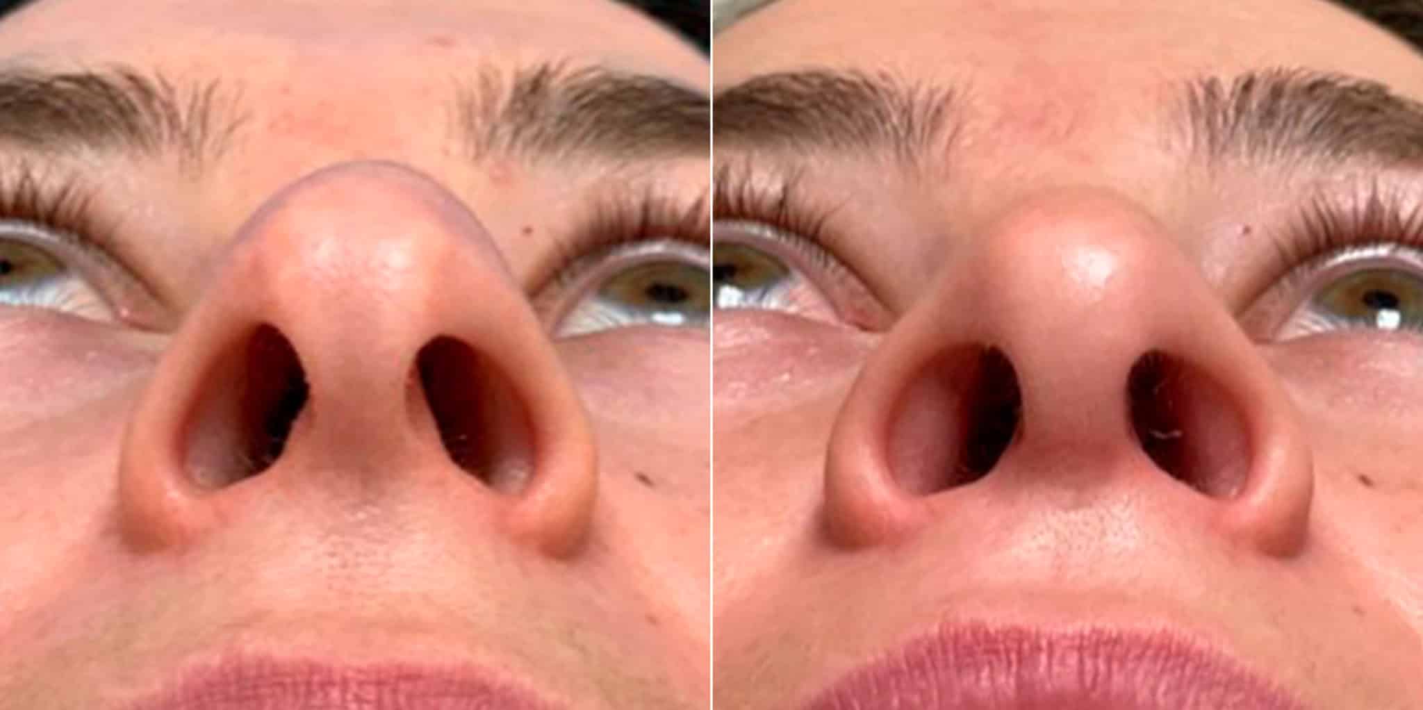 Bulbous Tip, Droopy Nose, Early AfterSurgery Results, Nasal Bump