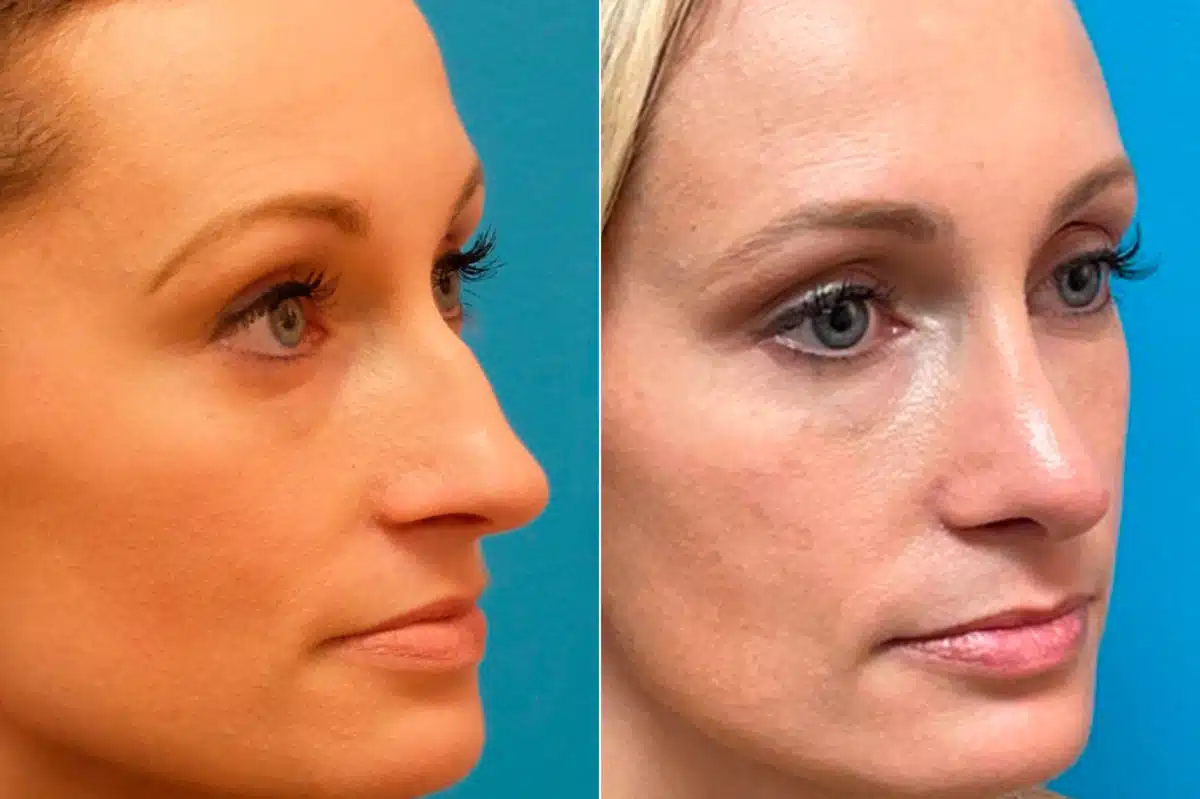 Finesse Rhinoplasty Before and After Photos in Sewell, NJ, Patient 9419