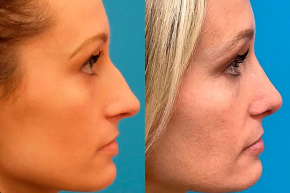 Finesse Rhinoplasty Before and After Photos in Sewell, NJ, Patient 9419