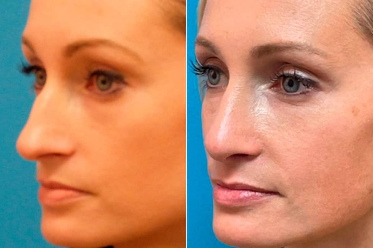 Finesse Rhinoplasty Before and After Photos in Sewell, NJ, Patient 9419