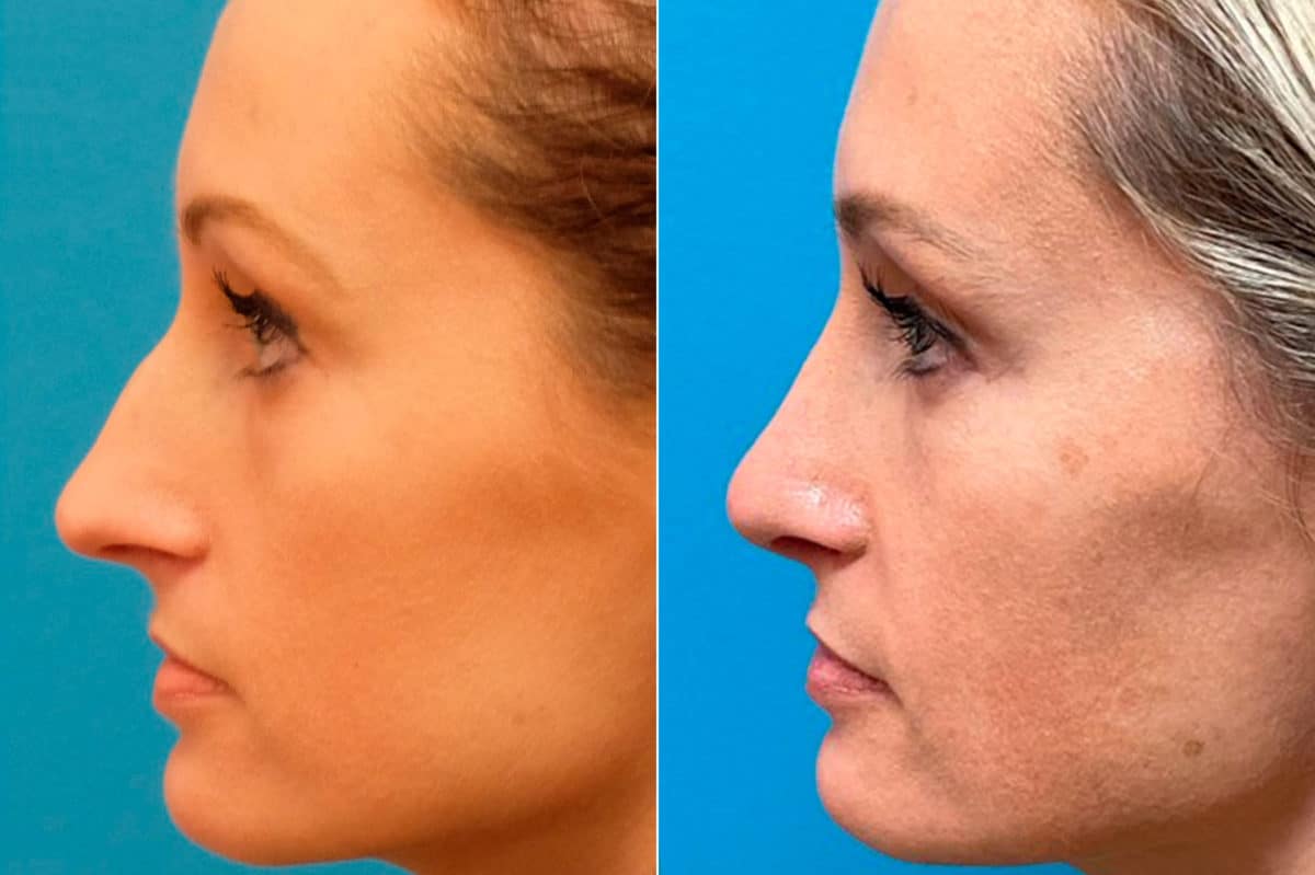 Finesse Rhinoplasty Before and After Photos in Sewell, NJ, Patient 9419