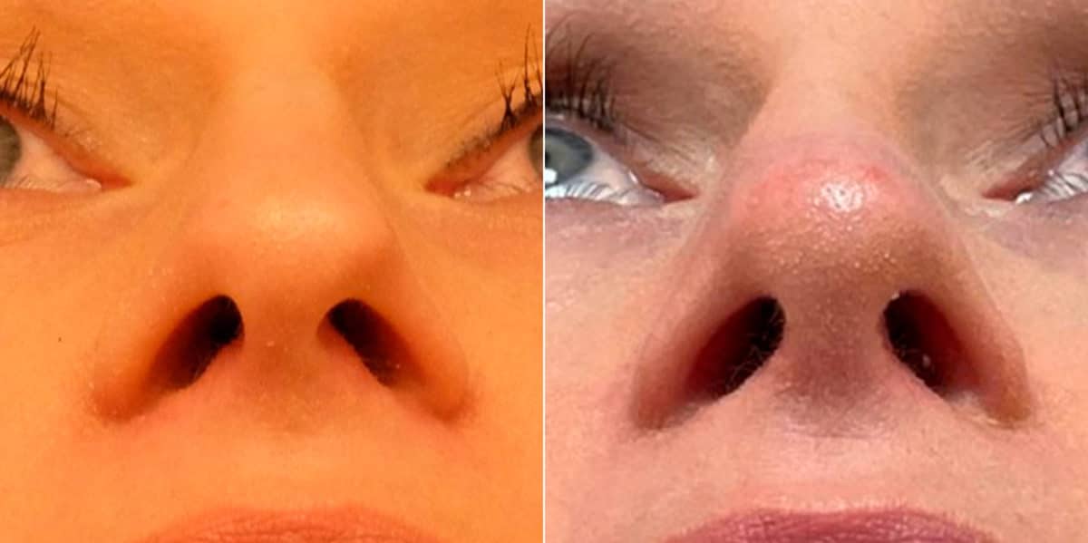 Finesse Rhinoplasty Before and After Photos in Sewell, NJ, Patient 9419