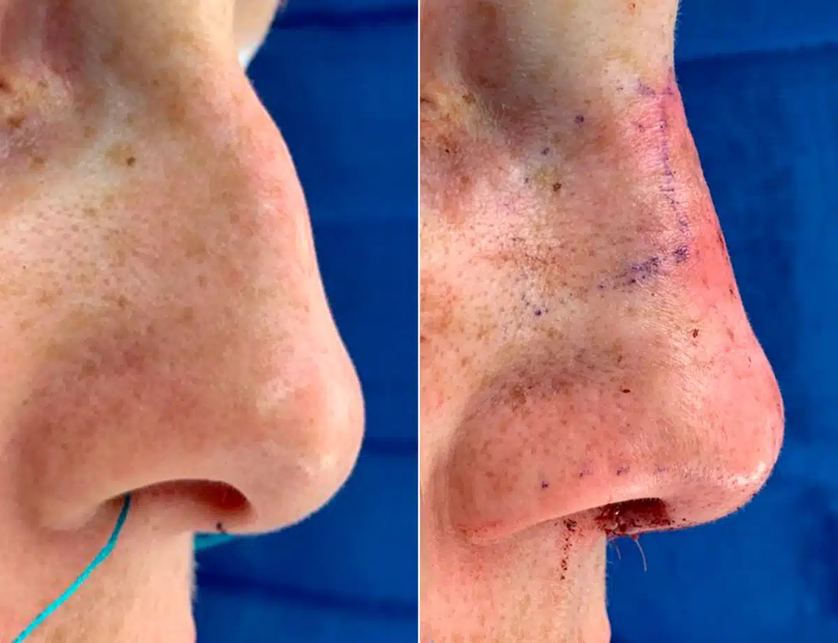 Early After-Surgery Results Before and After Photos in Sewell, NJ, Patient 9436