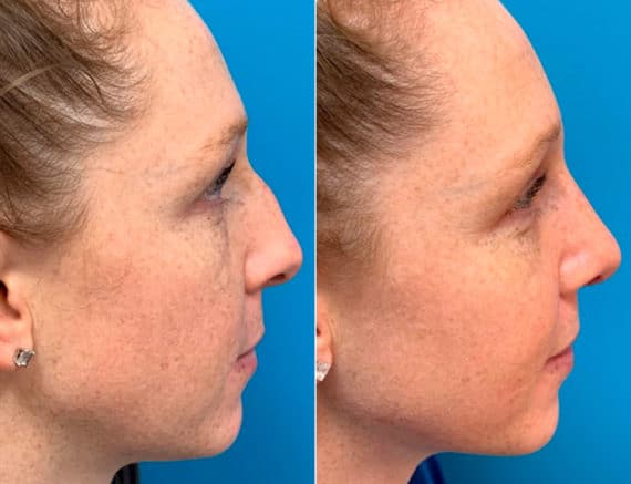 Early After-Surgery Results Before and After Photos in Sewell, NJ, Patient 9461