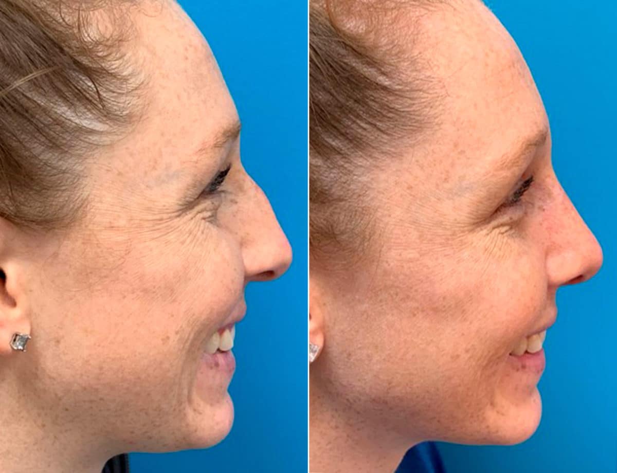 Early After-Surgery Results Before and After Photos in Sewell, NJ, Patient 9461