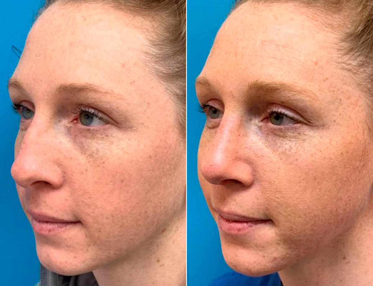 Early After-Surgery Results Before and After Photos in Sewell, NJ, Patient 9461