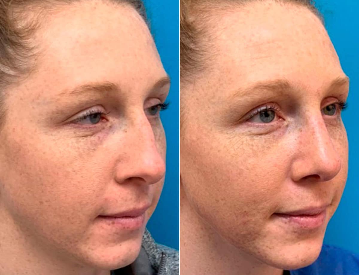 Early After-Surgery Results Before and After Photos in Sewell, NJ, Patient 9461