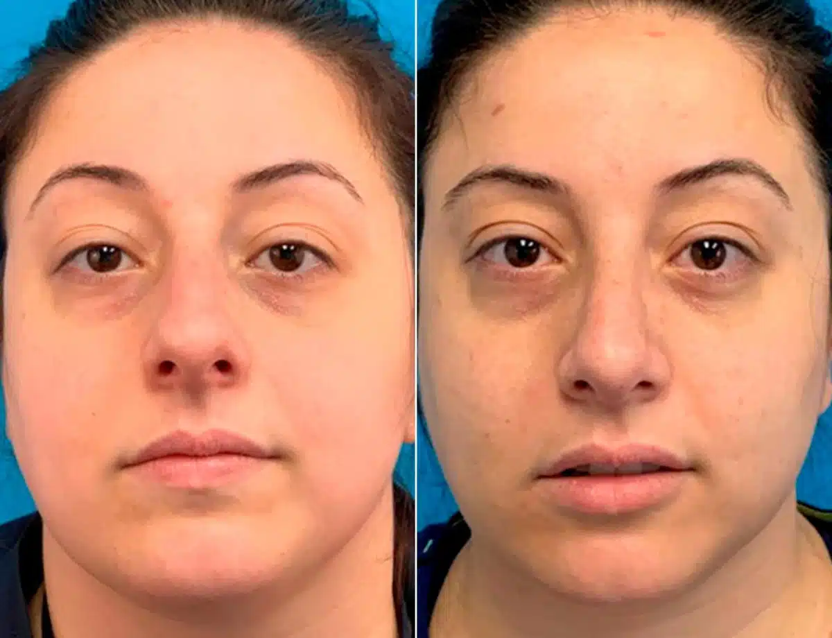 Early After-Surgery Results Before and After Photos in Sewell, NJ, Patient 9481