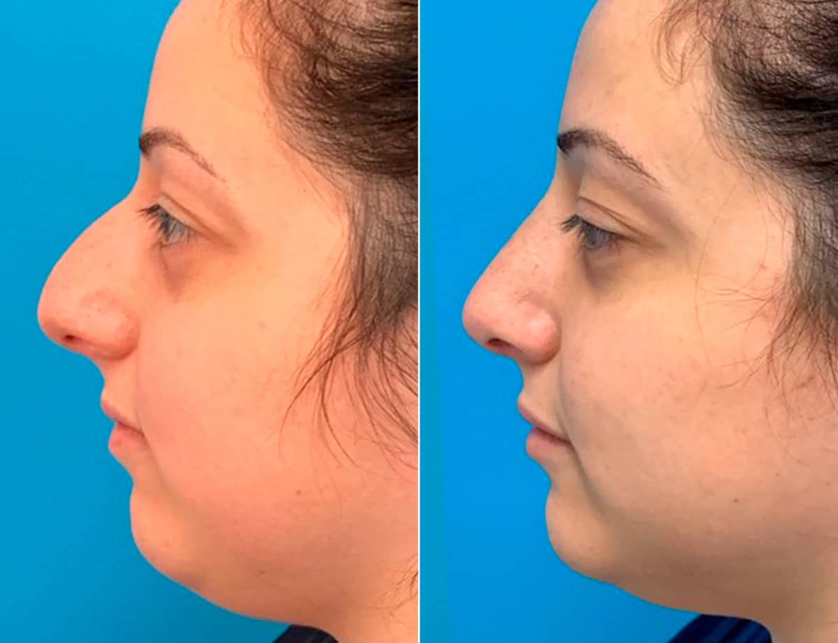 Early After-Surgery Results Before and After Photos in Sewell, NJ, Patient 9481