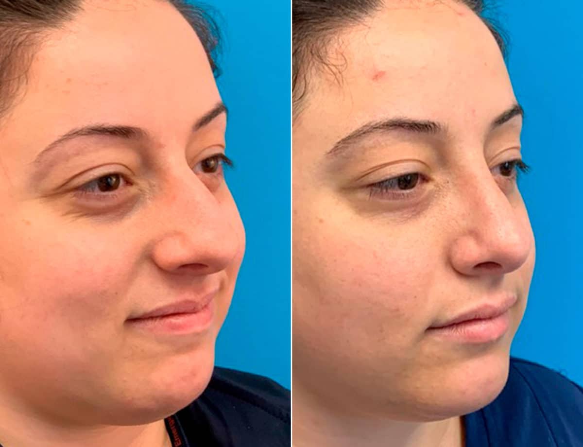 Early After-Surgery Results Before and After Photos in Sewell, NJ, Patient 9481