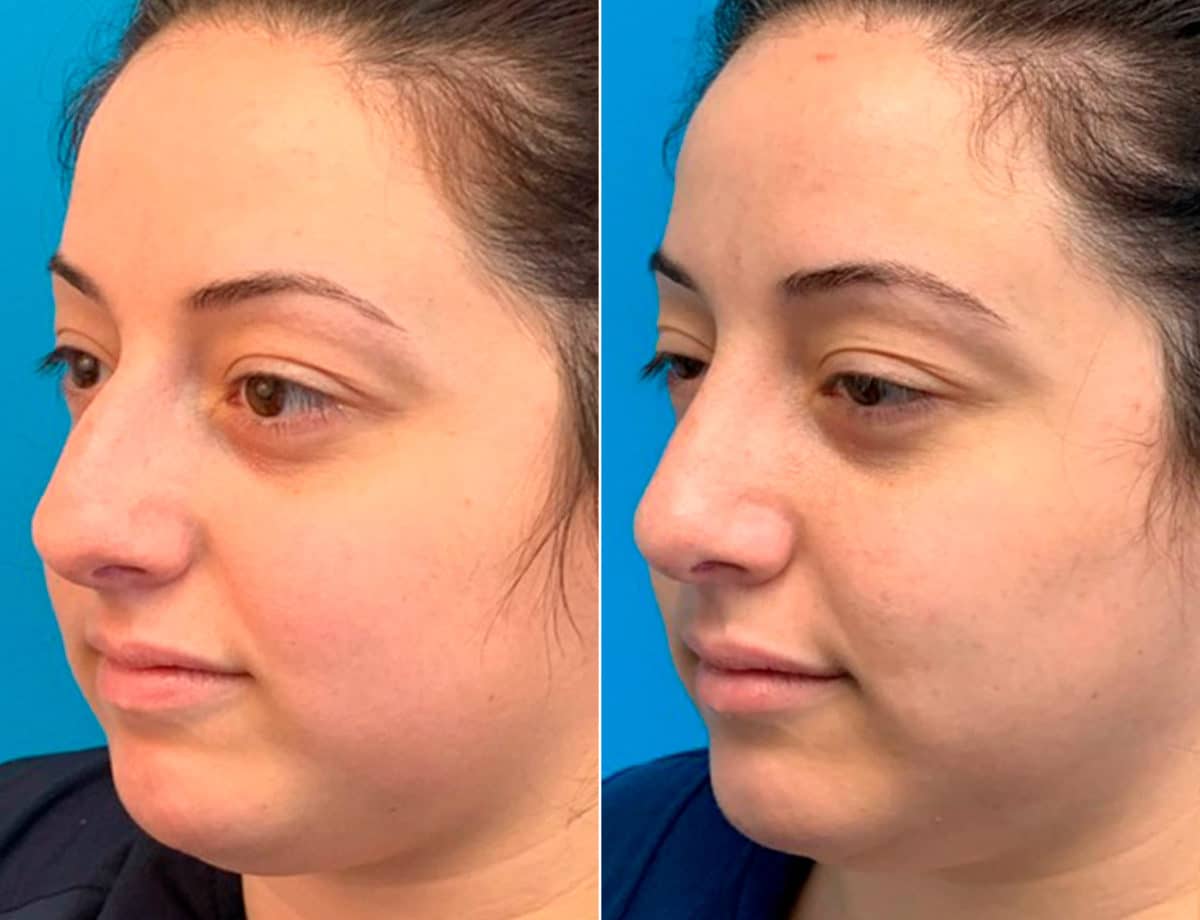 Early After-Surgery Results Before and After Photos in Sewell, NJ, Patient 9481