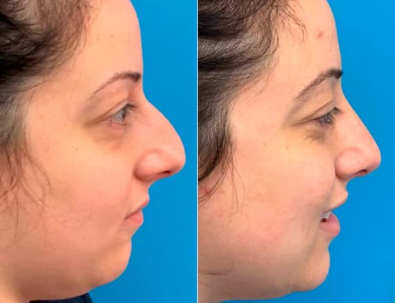 Early After-Surgery Results Before and After Photos in Sewell, NJ, Patient 9481