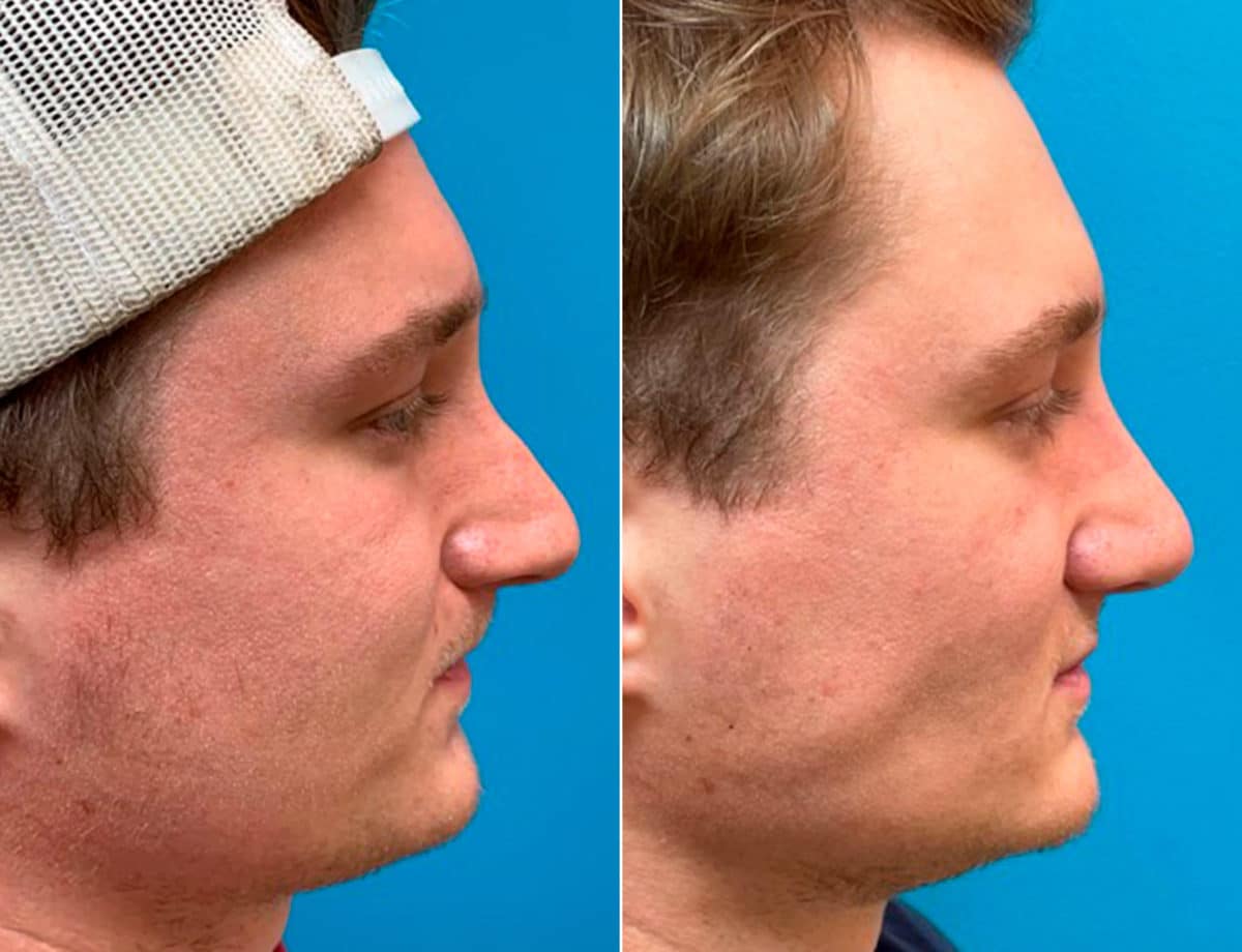 Early After-Surgery Results Before and After Photos in Sewell, NJ, Patient 9497