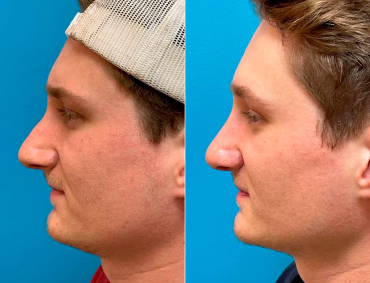 Early After-Surgery Results Before and After Photos in Sewell, NJ, Patient 9497