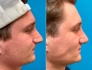 Early After-Surgery Results Before and After Photos in Sewell, NJ, Patient 9497