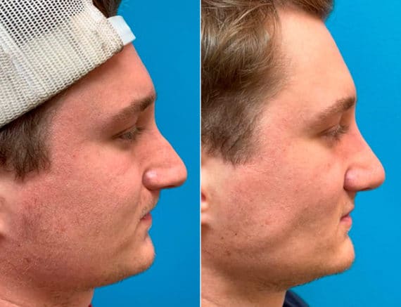 Early After-Surgery Results Before and After Photos in Sewell, NJ, Patient 9497