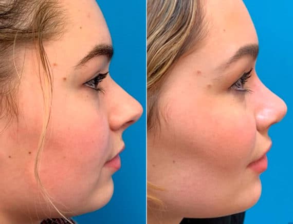 Early After-Surgery Results Before and After Photos in Sewell, NJ, Patient 9518