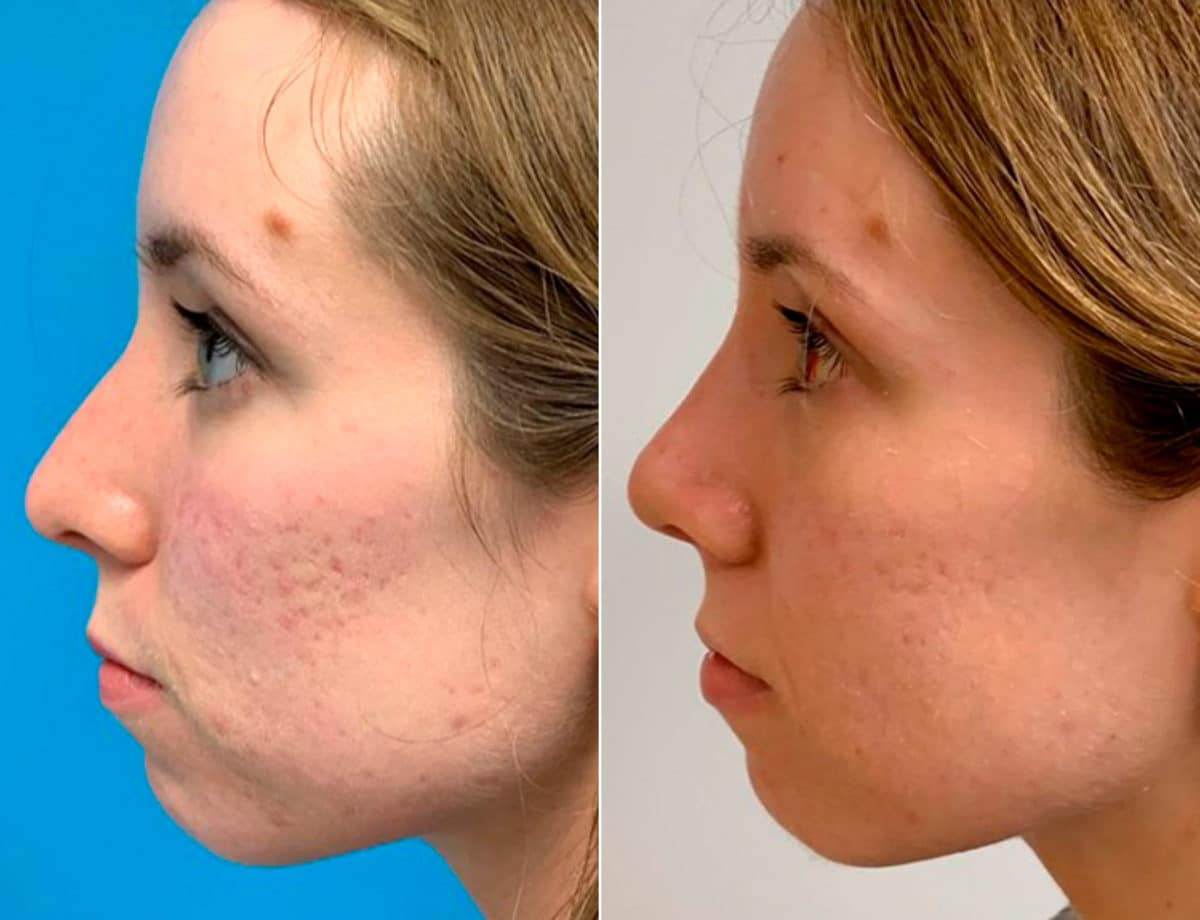 Early After-Surgery Results Before and After Photos in Sewell, NJ, Patient 9537