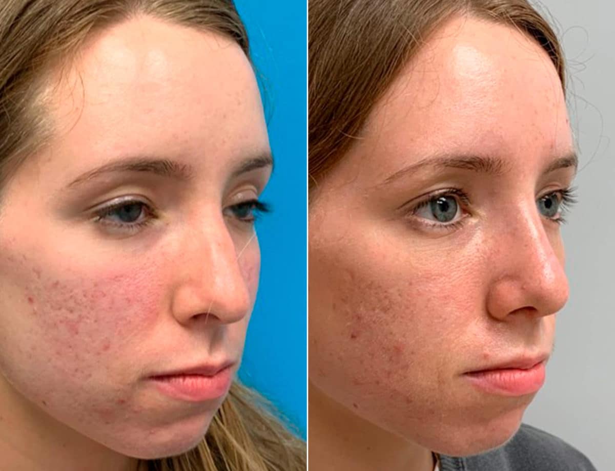 Early After-Surgery Results Before and After Photos in Sewell, NJ, Patient 9537