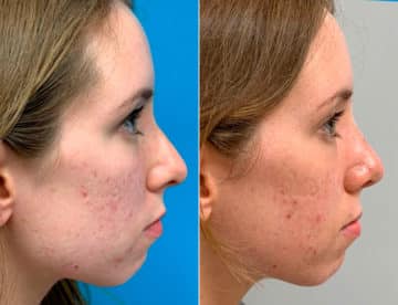 Early After-Surgery Results Before and After Photos in Sewell, NJ, Patient 9537