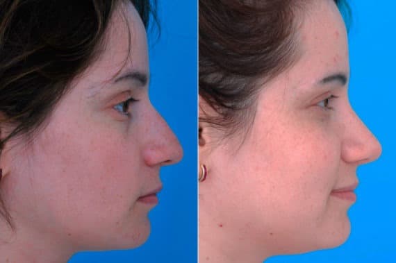 Bulbous Tip Before and After Photos in Sewell, NJ, Patient 9557