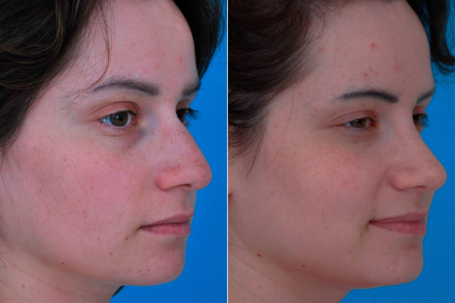 Bulbous Tip, Nasal Bump Photos Princeton, NJ Patient 9557