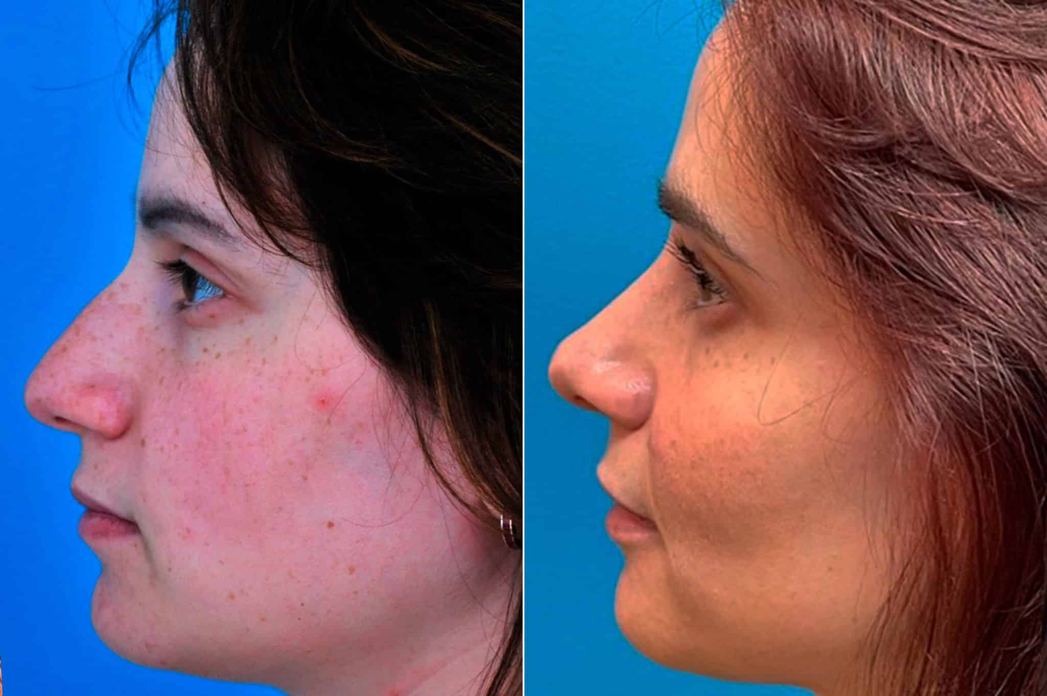 Bulbous Tip, Nasal Bump Photos Princeton, NJ Patient 9585