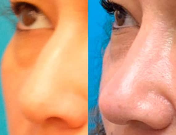 Early After-Surgery Results Before and After Photos in Sewell, NJ, Patient 9608