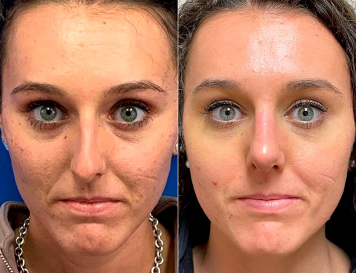 Patient 9651, Early After-Surgery Results Before and After Photos Early After-Surgery Results Before and After Photos in Sewell, NJ, Patient 9651