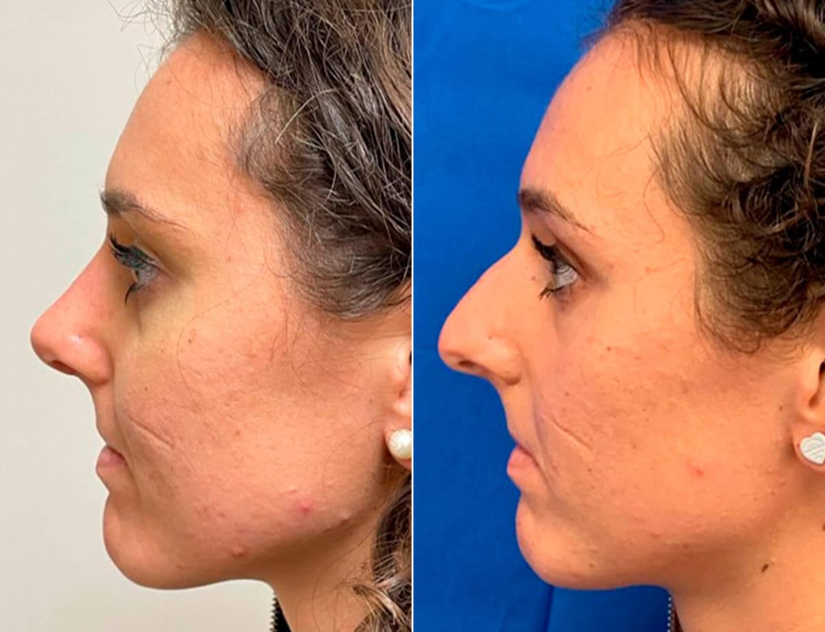 Patient 9651, Early After-Surgery Results Before and After Photos Early After-Surgery Results Before and After Photos in Sewell, NJ, Patient 9651