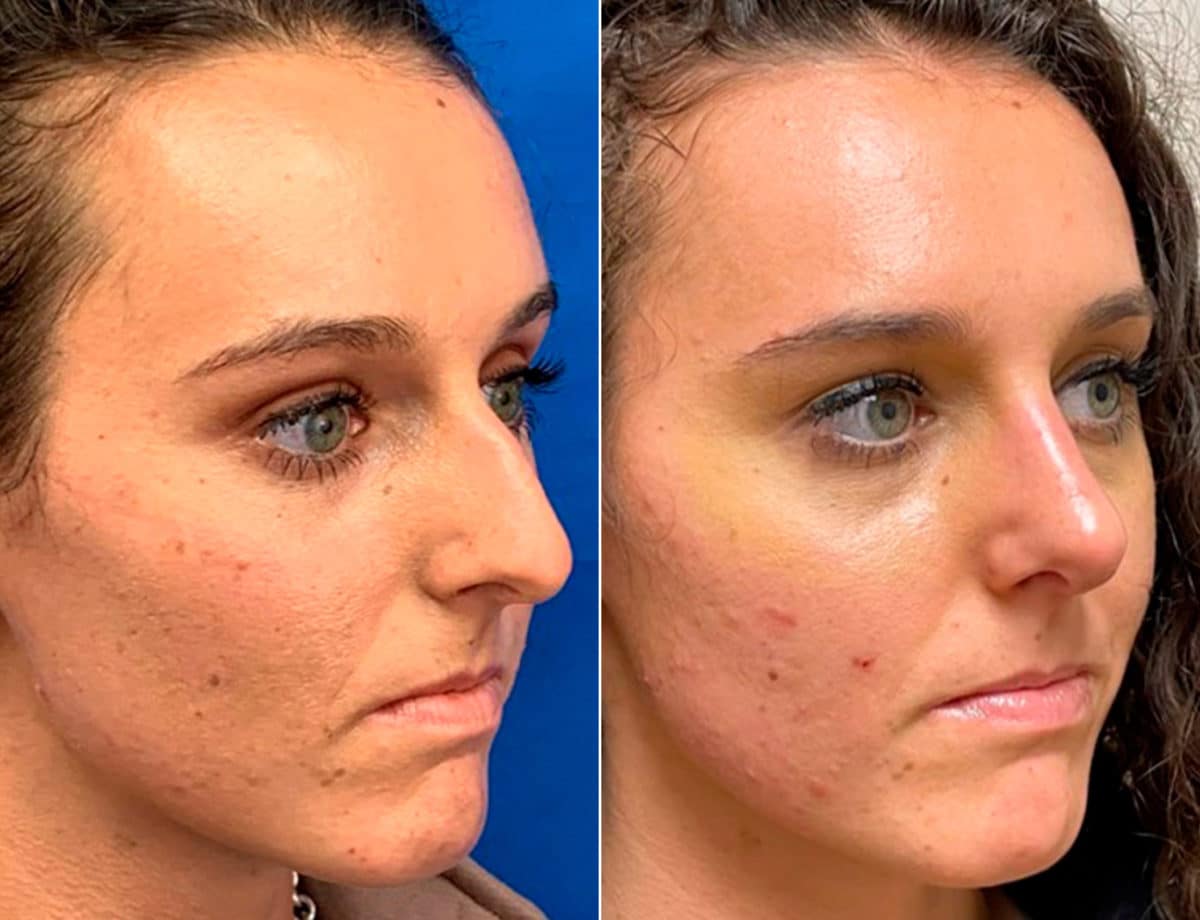 Early After-Surgery Results Before and After Photos in Sewell, NJ, Patient 9651