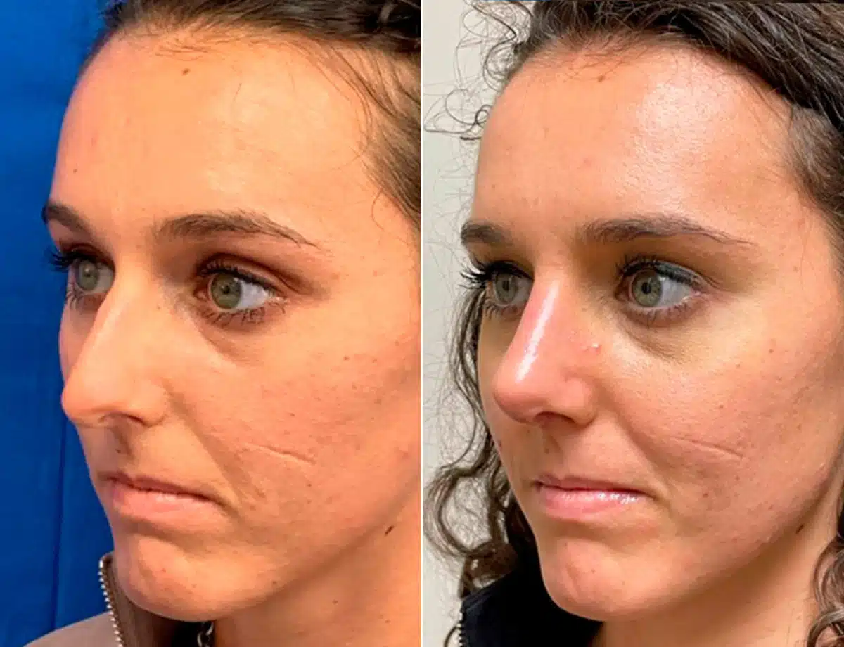 Early After-Surgery Results Before and After Photos in Sewell, NJ, Patient 9651