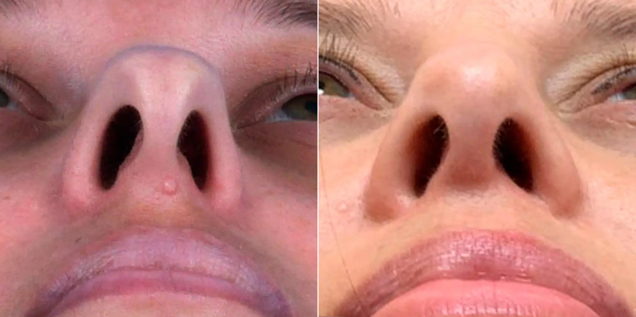 Bulbous Tip, Nasal Bump Photos Princeton, NJ Patient 9665