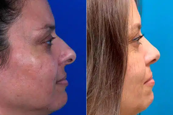 Bulbous Tip Before and After Photos in Sewell, NJ, Patient 9665