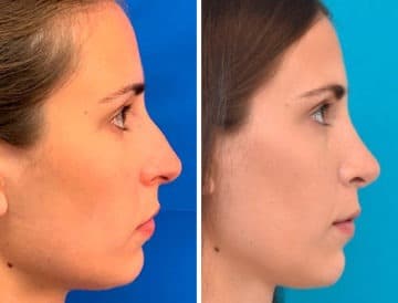 Nasal Fracture Before and After Photos in Sewell, NJ, Patient 9684