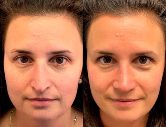 Early After-Surgery Results Before and After Photos in Sewell, NJ, Patient 9720