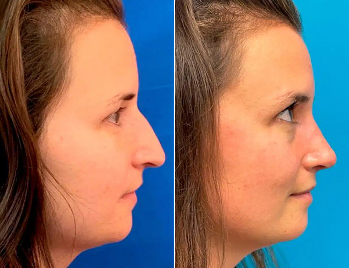 Early After-Surgery Results Before and After Photos in Sewell, NJ, Patient 9720