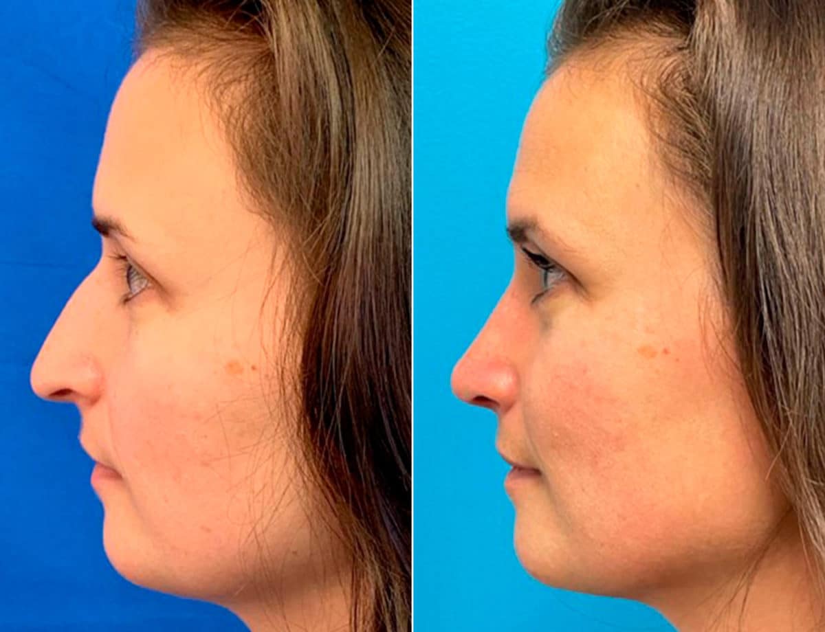 Early After-Surgery Results Before and After Photos in Sewell, NJ, Patient 9720