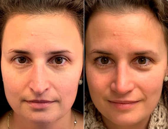 Early After-Surgery Results Before and After Photos in Sewell, NJ, Patient 9724