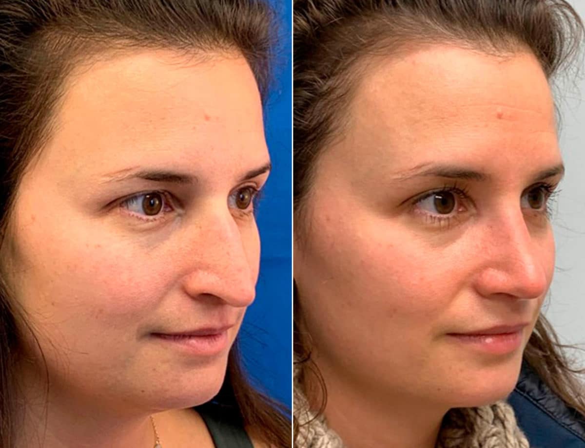 Early After-Surgery Results Before and After Photos in Sewell, NJ, Patient 9724