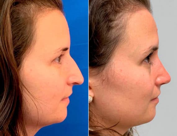 Early After-Surgery Results Before and After Photos in Sewell, NJ, Patient 9724