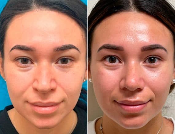 Early After-Surgery Results Before and After Photos in Sewell, NJ, Patient 9746