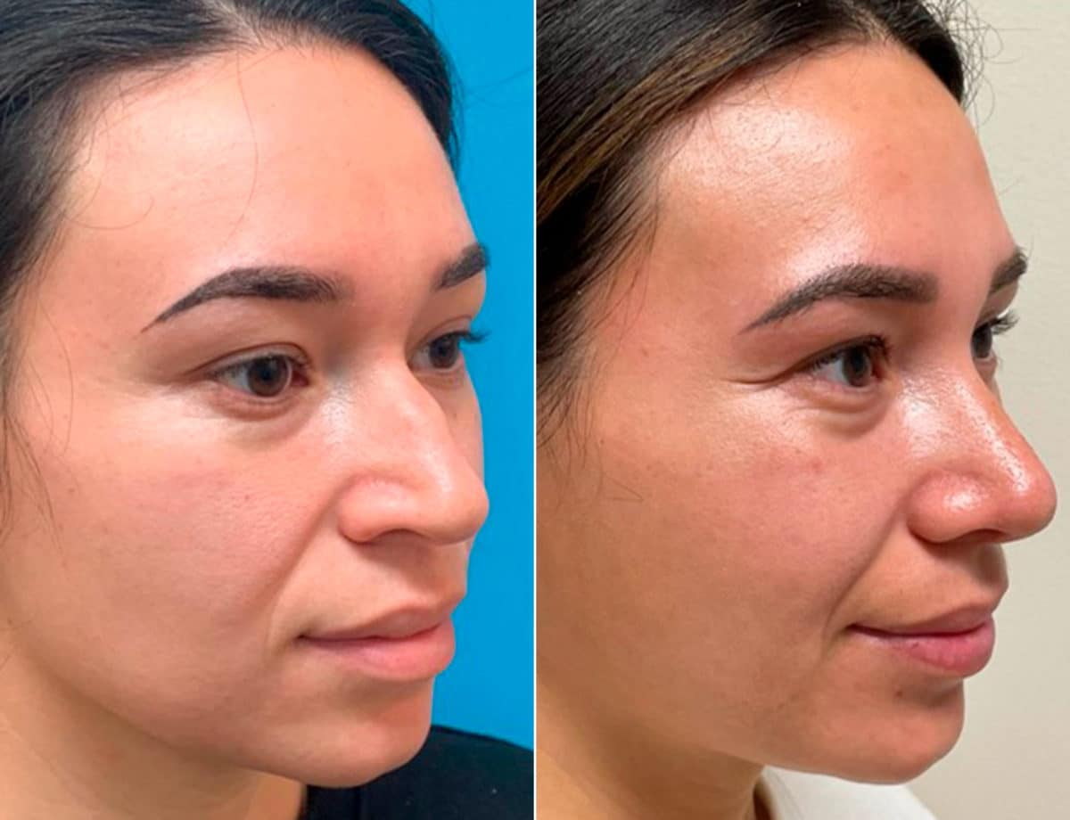 Early After-Surgery Results Before and After Photos in Sewell, NJ, Patient 9746