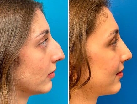 Twisted Nose Before and After Photos in Sewell, NJ, Patient 9901