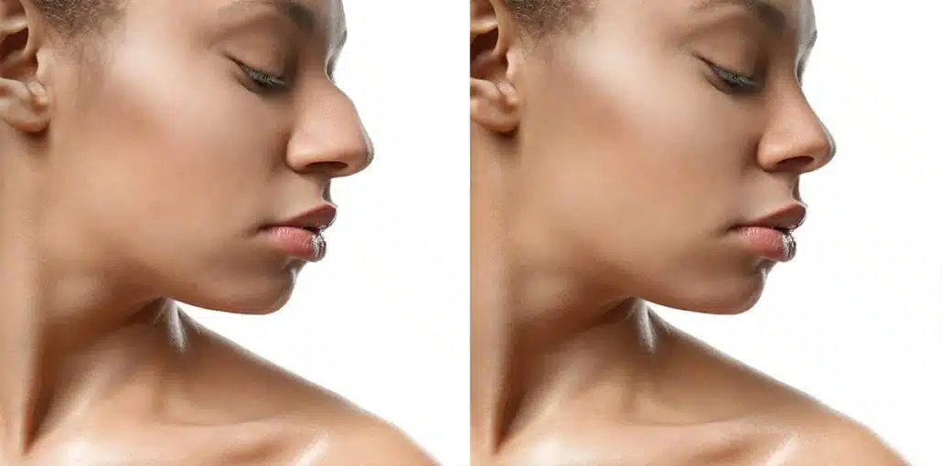 African American rhinoplasty recovery involves keeping the head elevated, applying cold compresses to reduce swelling, and avoiding strenuous activities for several weeks