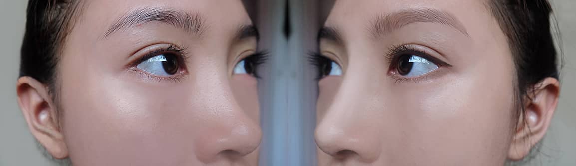 Asian rhinoplasty recovery typically involves swelling and bruising in the area around the nose that can last for several weeks