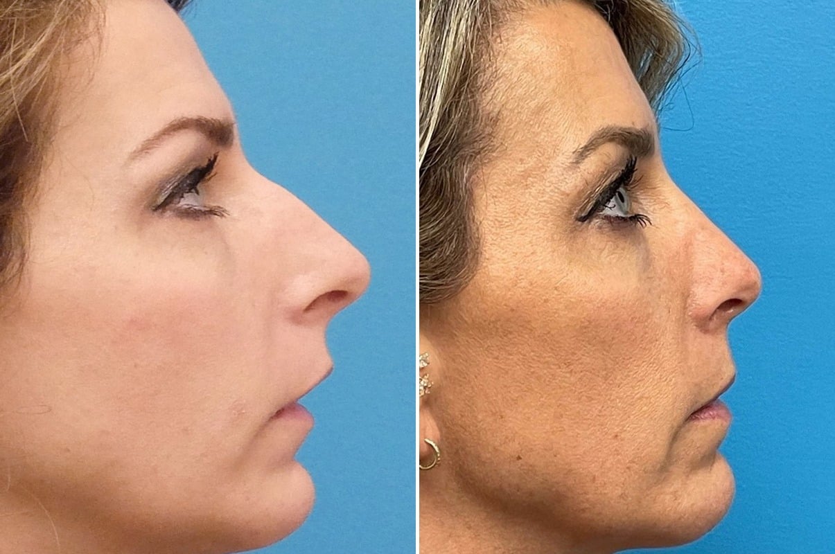 Bulbous Tip Photos Princeton, NJ Patient 10152