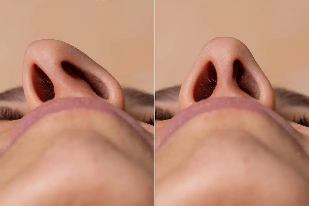 Understand what a deviated septum is, its symptoms, and the available treatment options.